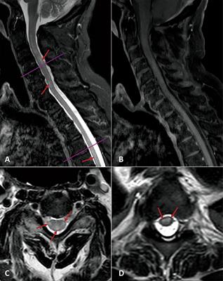 Acute Transverse Myelitis (ATM):Clinical Review of 43 Patients With COVID-19-Associated ATM and 3 Post-Vaccination ATM Serious Adverse Events With the ChAdOx1 nCoV-19 Vaccine (AZD1222)